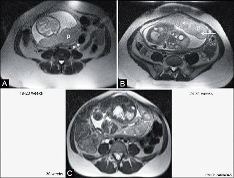 MRI normal placenta different gestational ages.jpg