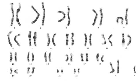 File:Klinefelter syndrome karyotype.jpg
