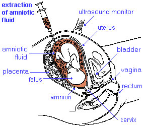File:Amniocentesis.jpg
