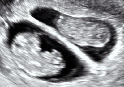 Dichorionic twins ultrasound 01.gif