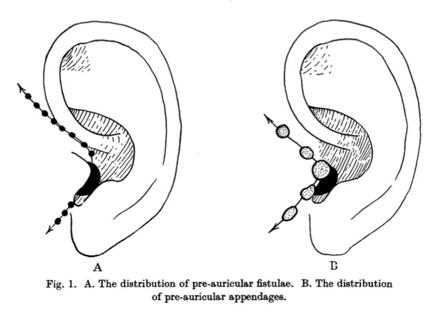 File:Pre-auricular fistulae and appendage locations.jpg