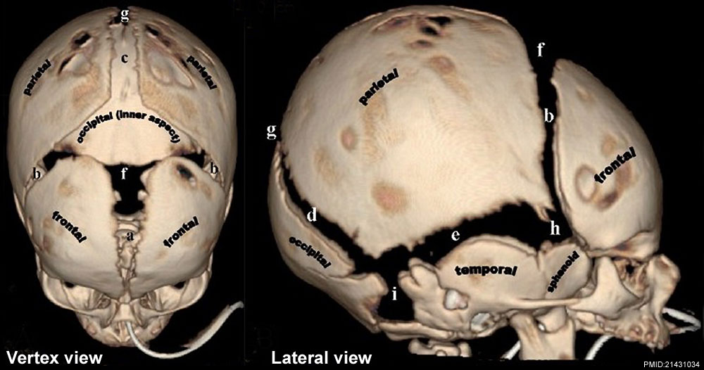 File:Skull CT normal sutures 01.jpg - Embryology
