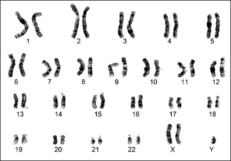 File:Karyotype of a Klinefelter's syndrome patient.jpg