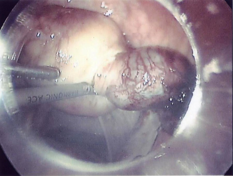 File:Interstitial-ectopic pregnancy.jpg