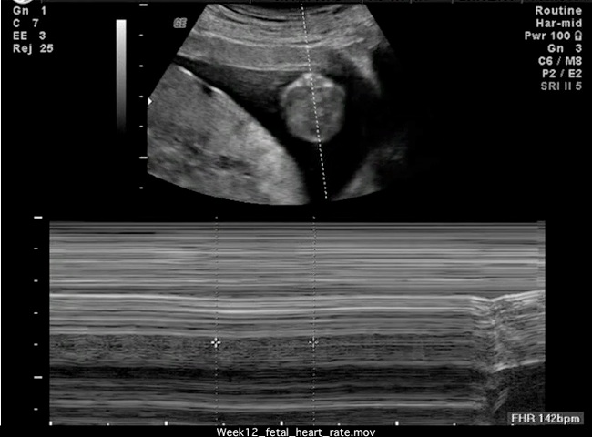 File:Week12 fetal heart rate-icon.jpg