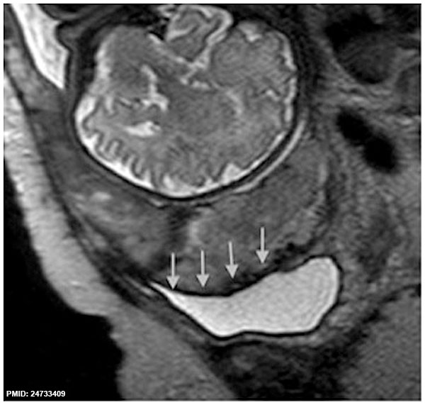 File:MRI Placenta Accreta 01.jpg