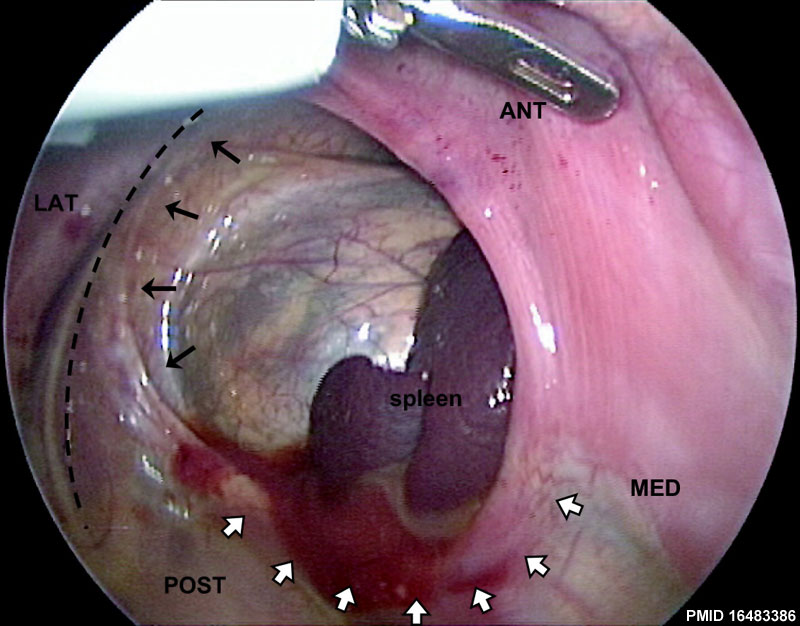 File:Human congenital diaphragmatic hernia.jpg - Embryology
