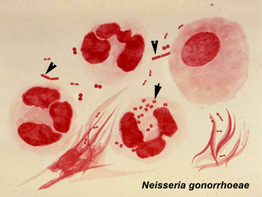 Abnormal Development - Gonorrhea - Embryology