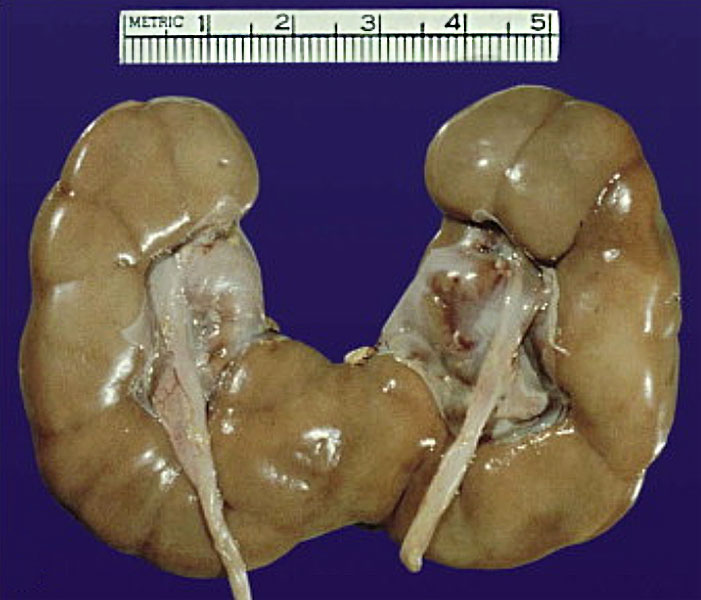 File:Horseshoe kidney 01.jpg