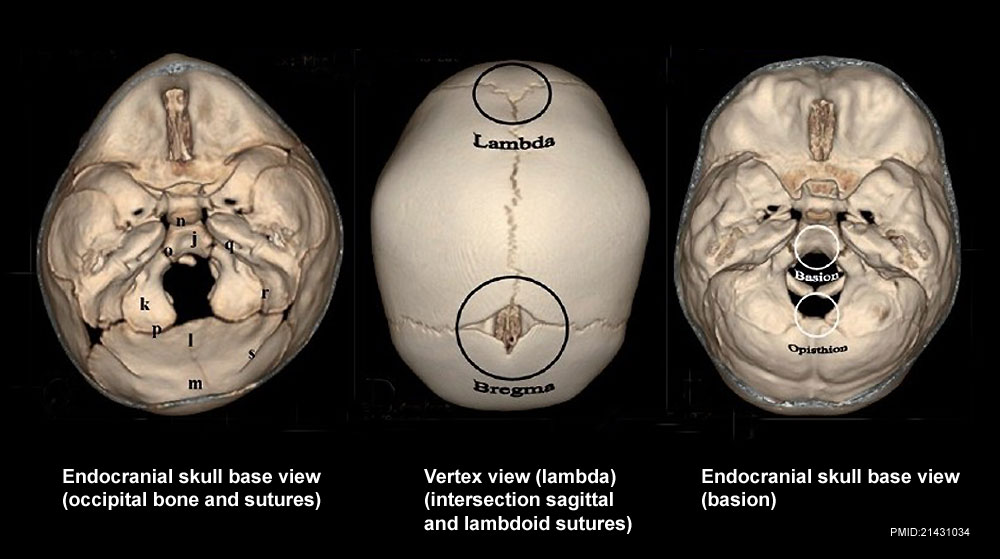 File:Skull CT normal sutures 02.jpg - Embryology