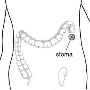 Megacolon stoma2.jpg