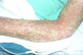 Figure 6: An example of a patient with psoriasis on their arm.