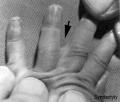 Syndactyly of the fingers - Existing Wiki image.