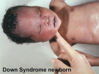Trisomy 21 newborn.jpg