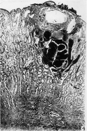 Blastocyst directly beneath the surface hemorrhage