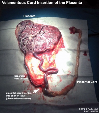 Placenta velamentous cord 02.jpg