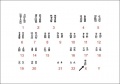 Karyotype very relevant to group topic. File name does not identify what the Karyotype actually is, as required by the file name criteria in assessment. While a link to the original image file on pubmed has been included, the citation has not been, as required by the file citation criteria in assessment. File description would have been improved by more accurately describing what is being shown and how this related to the project. It appears to be just the original figure legend without additional context.