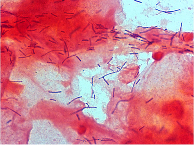File:Bacteria - gram-stained vaginal smear 03.jpg