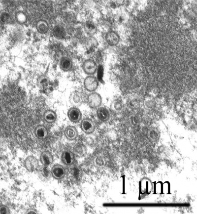 Cytomegalovirus virions EM.jpg