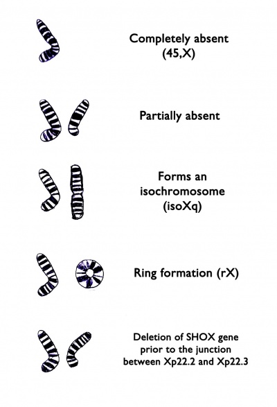 Turner Syndrome X Chromosome Variations.jpg
