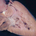 fig 45b Pulmonary atresia with intact ventricular septum
