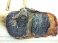 Bilobed placenta with velamentous cord insertion
