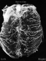 Fig. 3. Fetal Brain (6 month) Large Superficial Arteries