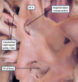 fig 21 Heart sinus venosus defect