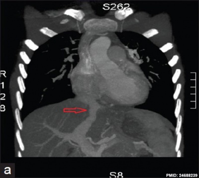 Postnatal persistant ductus venosus ultrasound 02.jpg