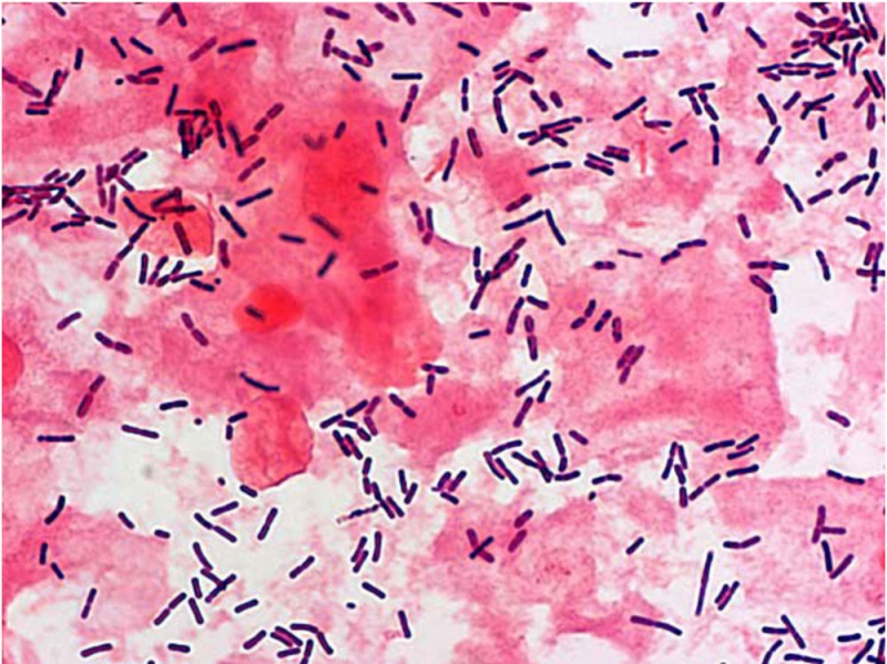 File:Bacteria - gram-stained vaginal smear 01.jpg