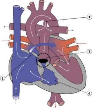 Pulmonary Atresia.jpg