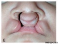 Complete bilateral cleft lip and palate