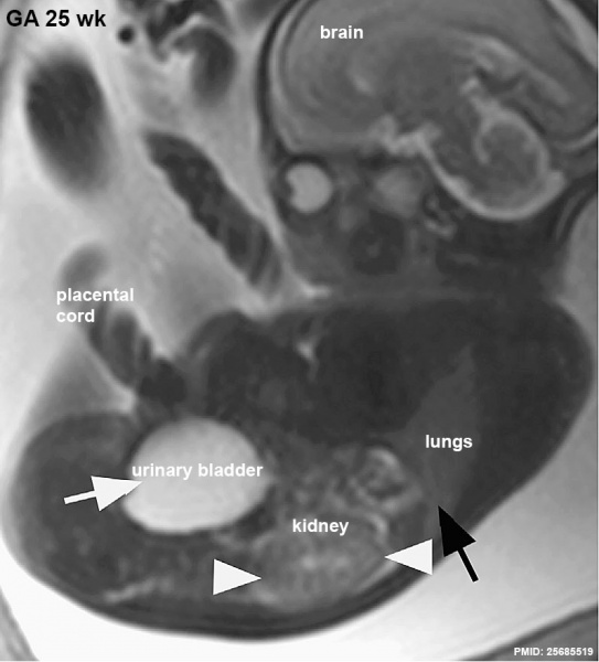 File:Fetal kidney MRI 01.jpg