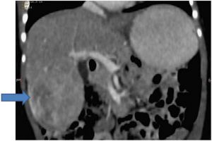 Mosaic Trisomy 18 hepatoblastoma CT