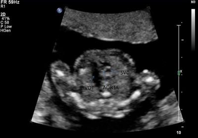 Ultrasound - Hypoplastic left heart syndrome 03.jpg