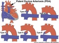 Patent ductus arteriosus classification