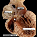 fig 11a Human ventricular septal defect