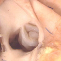 fig 43b Stenotic aortic valve