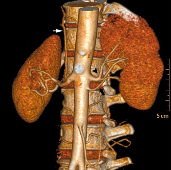 File:Accessory renal artery.jpg
