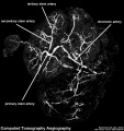 CT placental blood vessels
