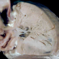 fig 45a Pulmonary atresia with intact ventricular septum