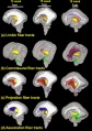 Brain tract development 01.jpg