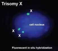 Trisomy X
