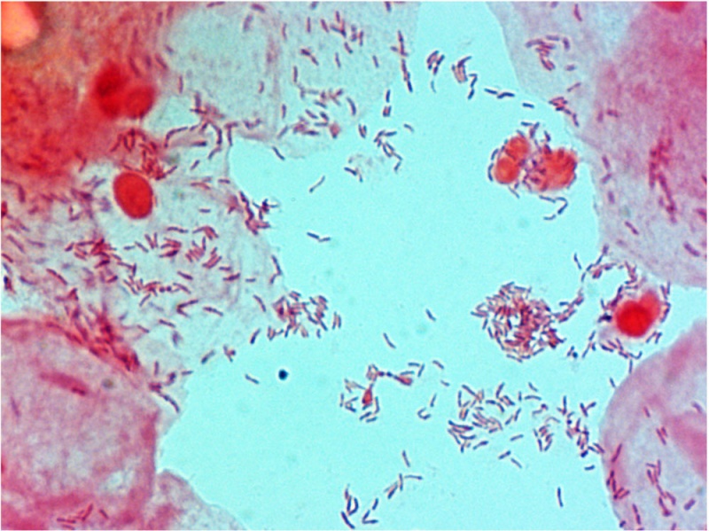 File:Bacteria - gram-stained vaginal smear 12.jpg
