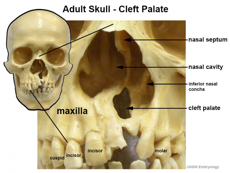 File:Adult skull cleft palate 03.jpg