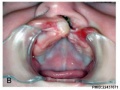 Uniateral Cleft Lip