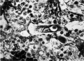 Fig 29 Trophoblastic cell phagocytized lymphoyte