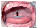 Incomplete Cleft Palate (Involving only the soft palate and uvula)