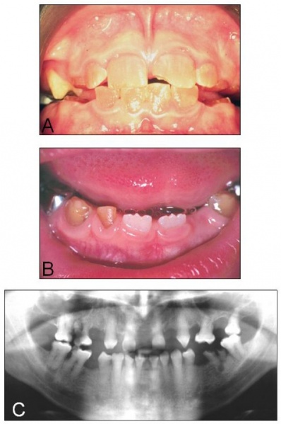 File:Inherited dentine disorders.jpg