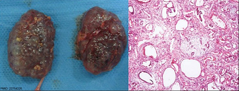 File:Multicystic kidney and histology.jpg